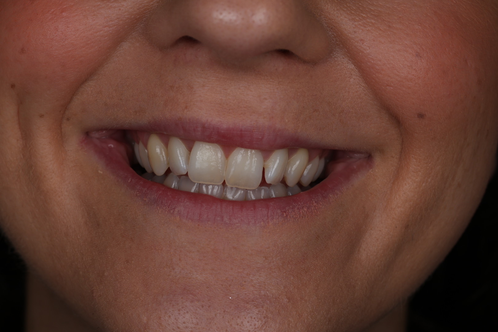 Before — Smile transformations
