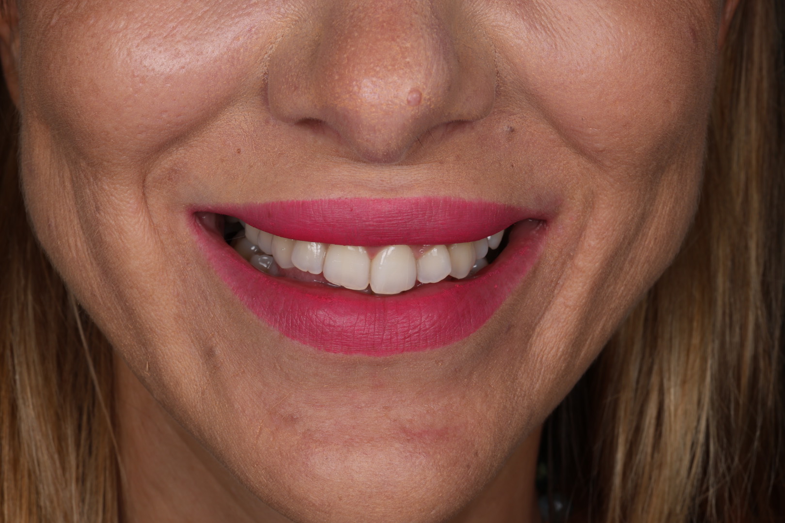 Before — Smile transformations