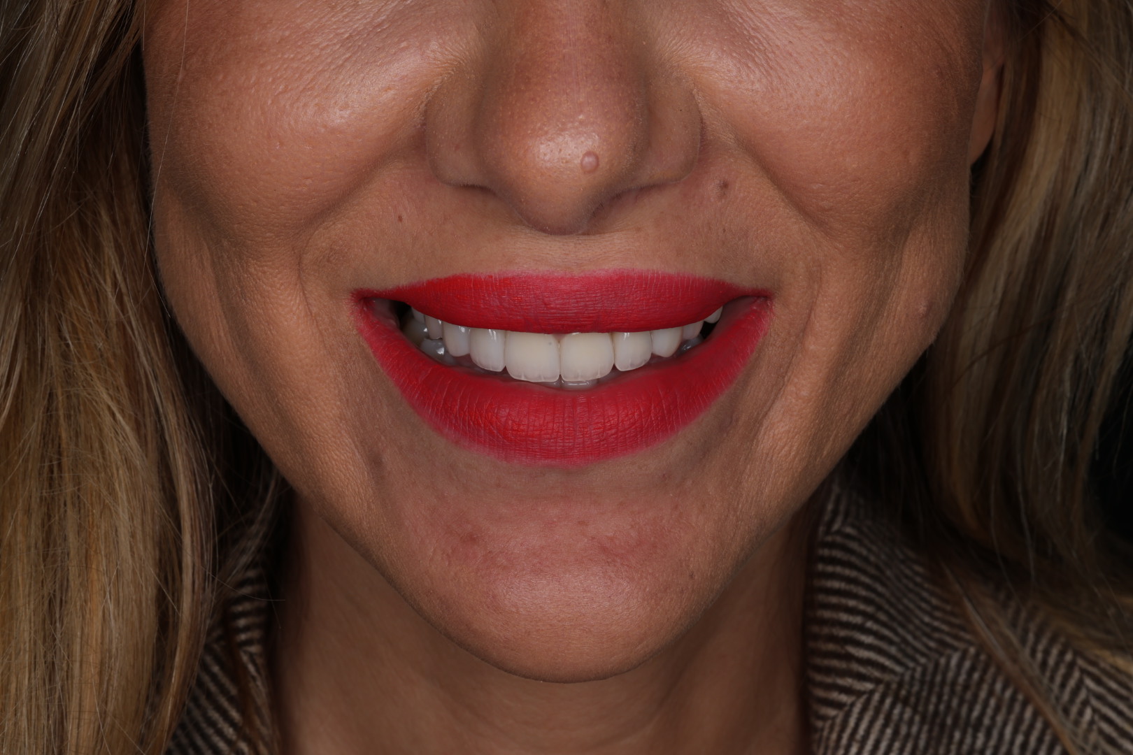 After — Smile transformations