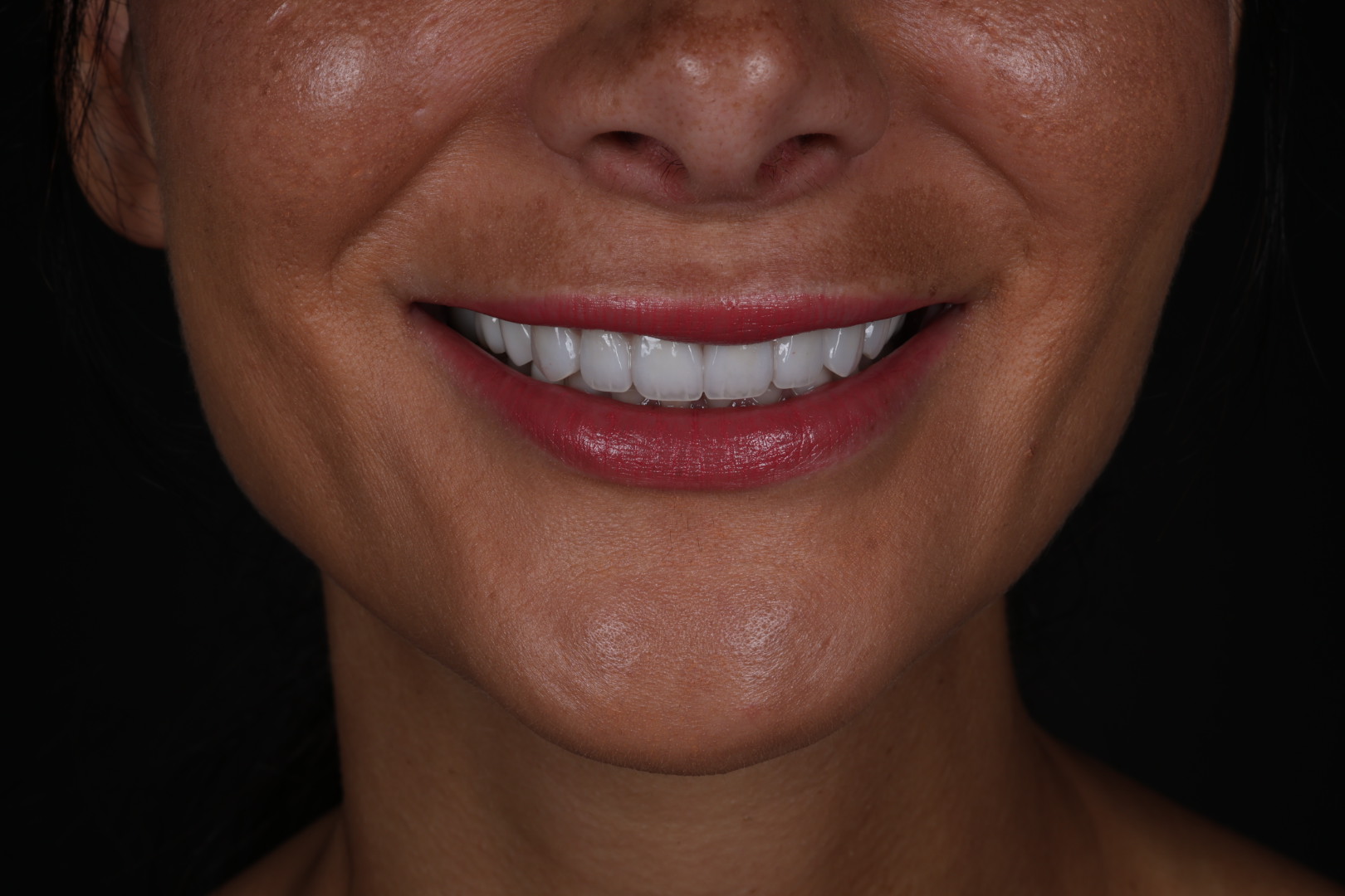 After — Smile transformations