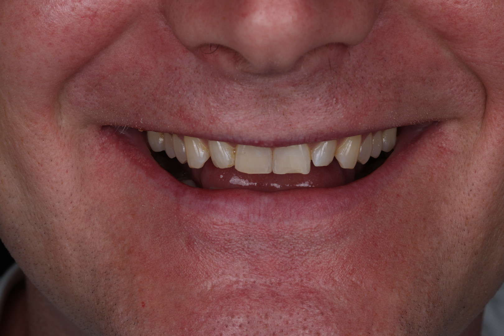 Before — Smile transformations