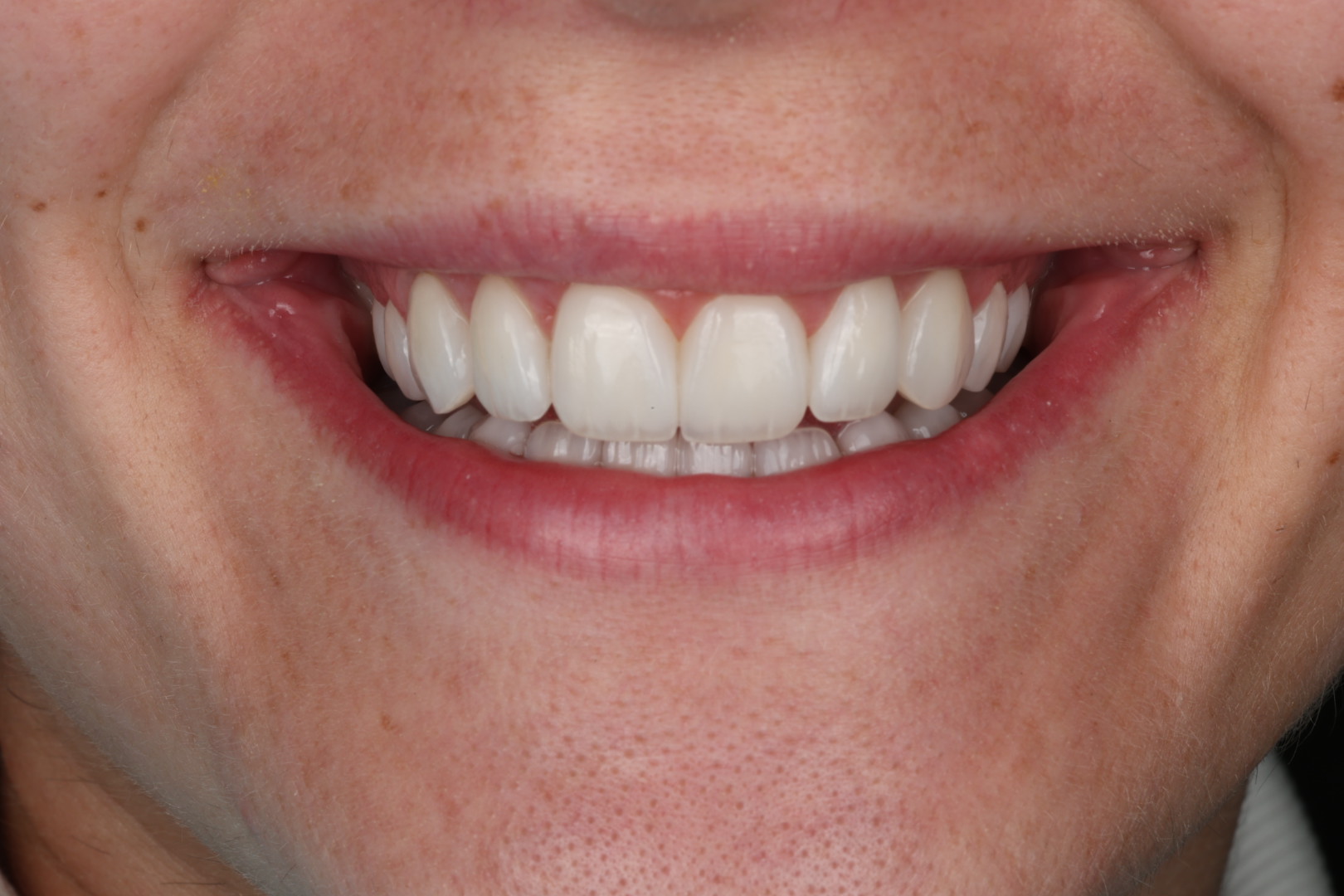 After — Smile transformations
