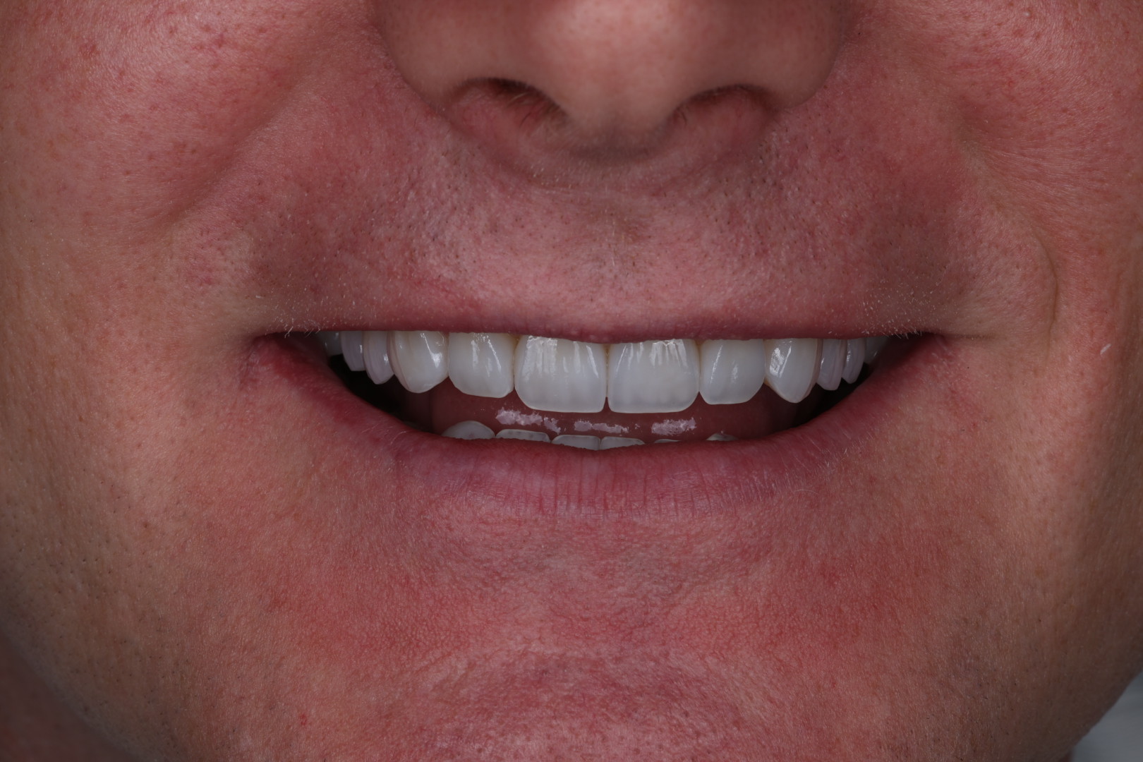 After — Smile transformations