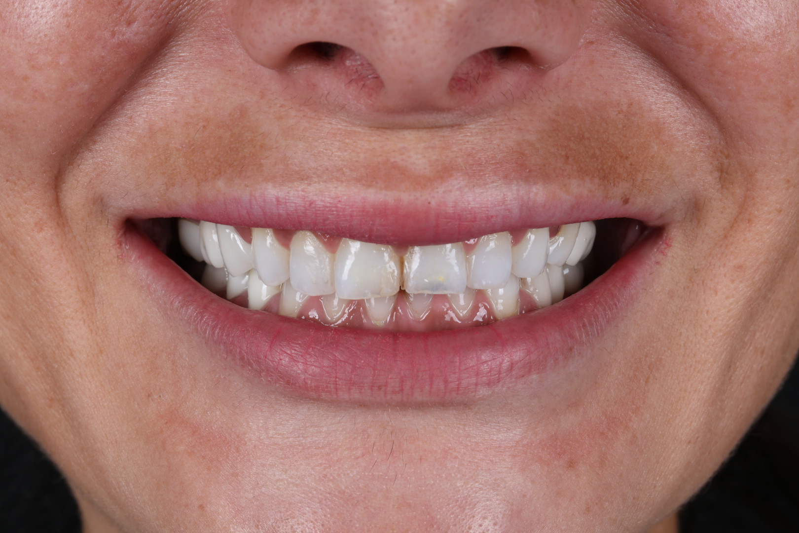 Before — Smile transformations